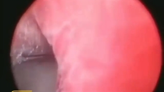 جراحی هیستروسکوپی