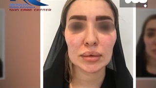 فیلم واقعی تزریق چربی در مطب دکتر مولازاده