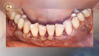 فیلم واقعی جراحی پیوند لثه
