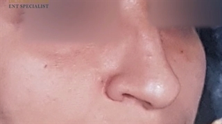 سه هفته بعد از جراحی بینی