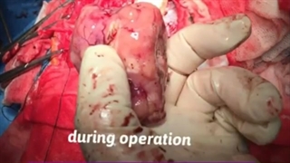 جراحی تومور مغزی در خانوم 32 ساله