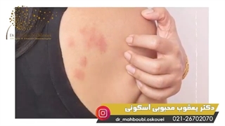 علل ایجاد کهیر(علل دارویی)