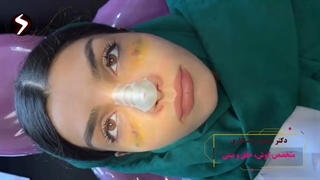 نحوه ی چسب زدن بعد از عمل بینی