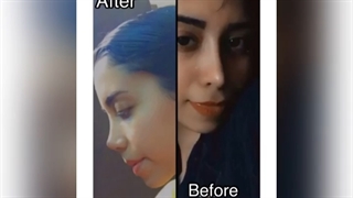 نمونه جراحی بینی