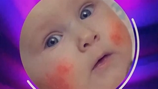 آلرژی به پروتئین گاوی در نوزادان چگونه درمانی می شود؟