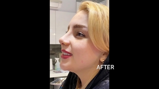جراحی بینی + عکس قبل و بعد بلیچینگ