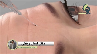 توضیحاتی کامل از مزوتراپی