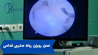 عمل رویژن رباط صلیبی قدامی توسط دکتر پویان علوی نژاد