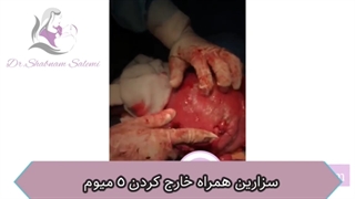 فیلم کامل بدون سانسور سزارین همراه خارج کردن ٥ میوم