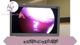 فیلم واقعی لاپاراسکوپی هیسترکتومی