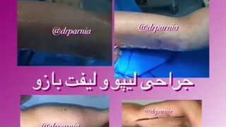 جراحی لیپو و لیفت بازو