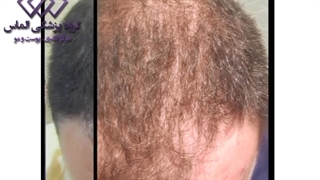 فیلم قبل و بعد مزوتراپی مو