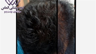 نتیجه مزوتراپی بعد از 6 جلسه