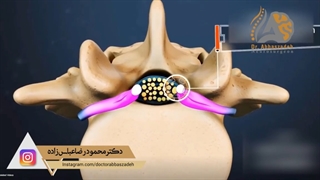 درباره بیماری تنگی کانال نخاعی کمر چه می دانید؟