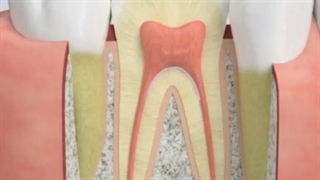 فیلم پوسیدگی ریشه دندان