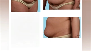 فیلم کوچک کردن شکم با عمل ابدومینوپلاستی