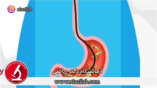 هلیکوباکترپیلوری ، علائم و راههای تشخیص