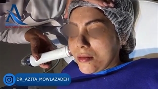 فیلم واقعی آر اف فرکشنال جهت جوانسازی پوست