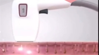 آیا لیزر موهای زائد به بدن سرطان زا است؟ ترمیم ونیر