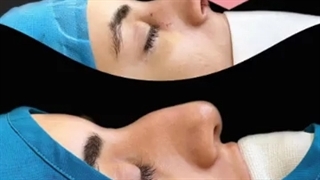 جراحی بینی توسط بهترین دکتر تهران هزینه مزایا و عوارض