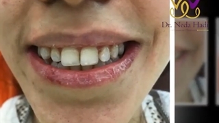 فیلم واقعی کامپوزیت ونیر هر دو فک