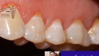 پیوند لثه و پوشش سطح ریشه