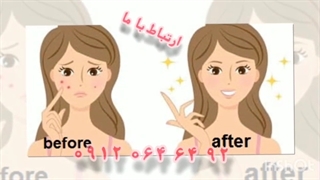 ژل ضد جوش و آکنه سروینا کامپوزیت ونیر