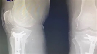 فیلم واقعی از جراحی زانوی پرانتزی در اتاق عمل توسط دکتر کوکبی