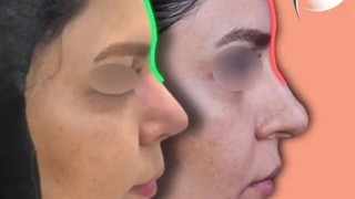 نمونه عمل زیبایی بینی