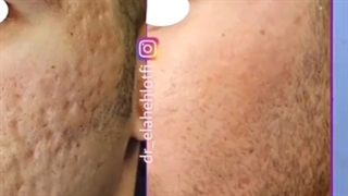 ورکشاپ آموزشی آفرودیت اندو ار اف