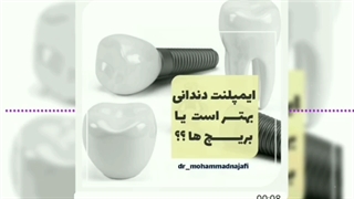ایمپلنت دندان