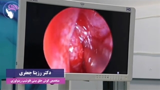 پولیپ و سینوزیت مزمن باهم همراهی دارن؟