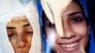 فیلم واقعی عمل بینی گوشتی در اتاق عمل