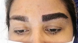 کاشت ابرو بدون جراحی میکرونیدلینگ
