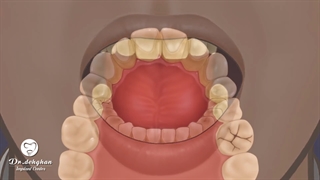 جرم گیری دندان