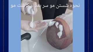 مراقبت بعد از کاشت مو