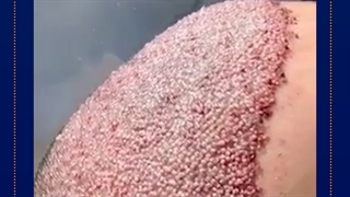 کاشت مو ارزان