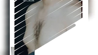 فیلم واقعی جراحی ژنیکوماستی