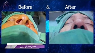 قبل و بعد از عمل زیبایی بینی