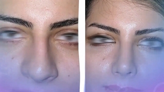 عمل بینی قبل و بعد