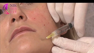 آموزش مزو درماهیل جوانساز HSR