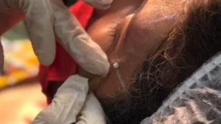 تزریق نخ کلاژن ساز برای جوانسازی پوست و رفع  خطوط اطراف چشم # 09120660447