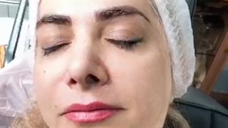 رفع خط خنده و اندوه با نخ کلاژن ساز # 09120660447