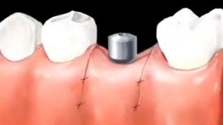 مراحل کاشت ایمپلنت دندان - کلینیک دندانپزشکی آرمان