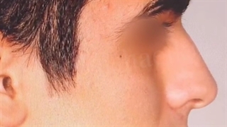 جراحی زیبایی بینی