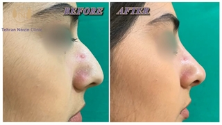 تفاوت مزوتراپی بینی و اصلاح فرم بینی| کلینیک تهران نوین