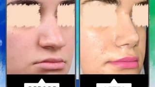 نمونه جراحی بینی ( 5 ماه بعد از عمل جراحی )