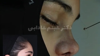 جراحی بینی با ارتفاع  کم و پوست ضخیم