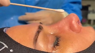 جراحی بینی گوشتی