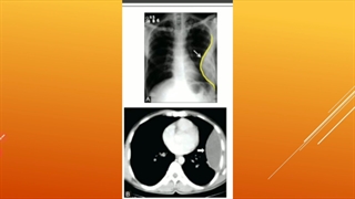 مقدمات بیماری های تنفس جلسه 8